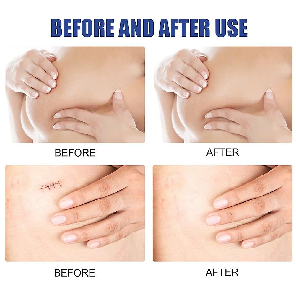 Silicone Breast Reduction After Surgery for Scars Scar Removal Sheets 4 Pairs